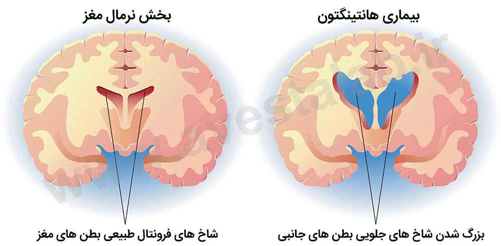 بیماری هانتینگتون