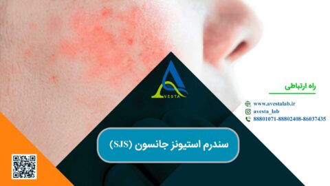 سندرم استیونز جانسون (SJS)