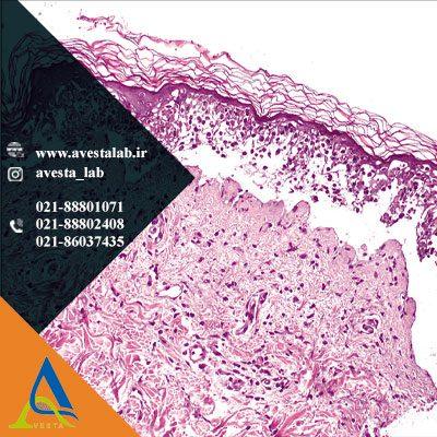 سندرم استیونز جانسون (SJS)