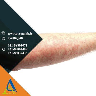 سندرم استیونز جانسون (SJS)
