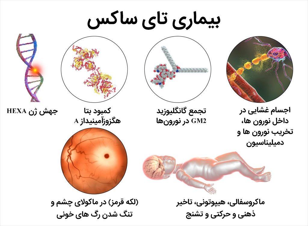 بیماری تای ساکس