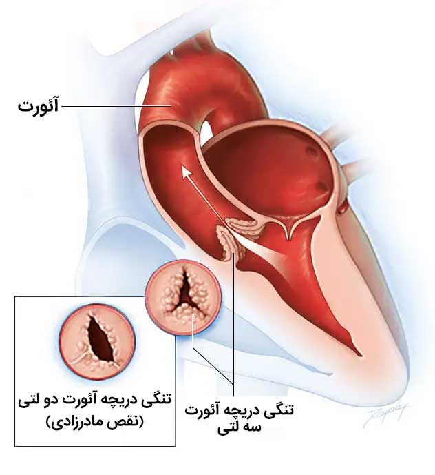 تنگی دریچه آئورت