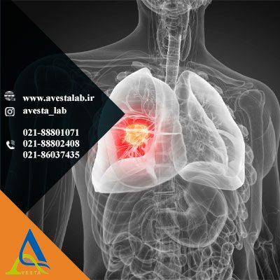 آزمایش های شایع غربالگری سرطان