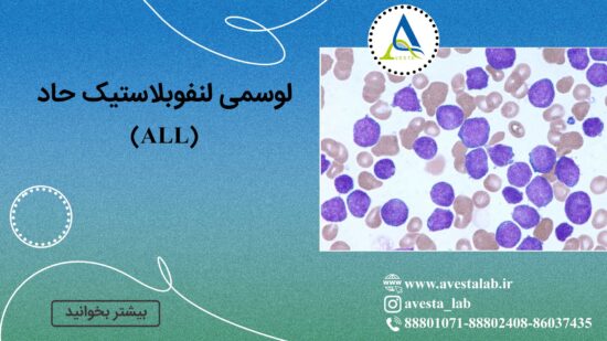 لوسمی لنفوبلاستیک حاد (ALL)
