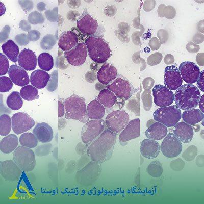 لوسمی لنفوبلاستیک حاد (ALL)