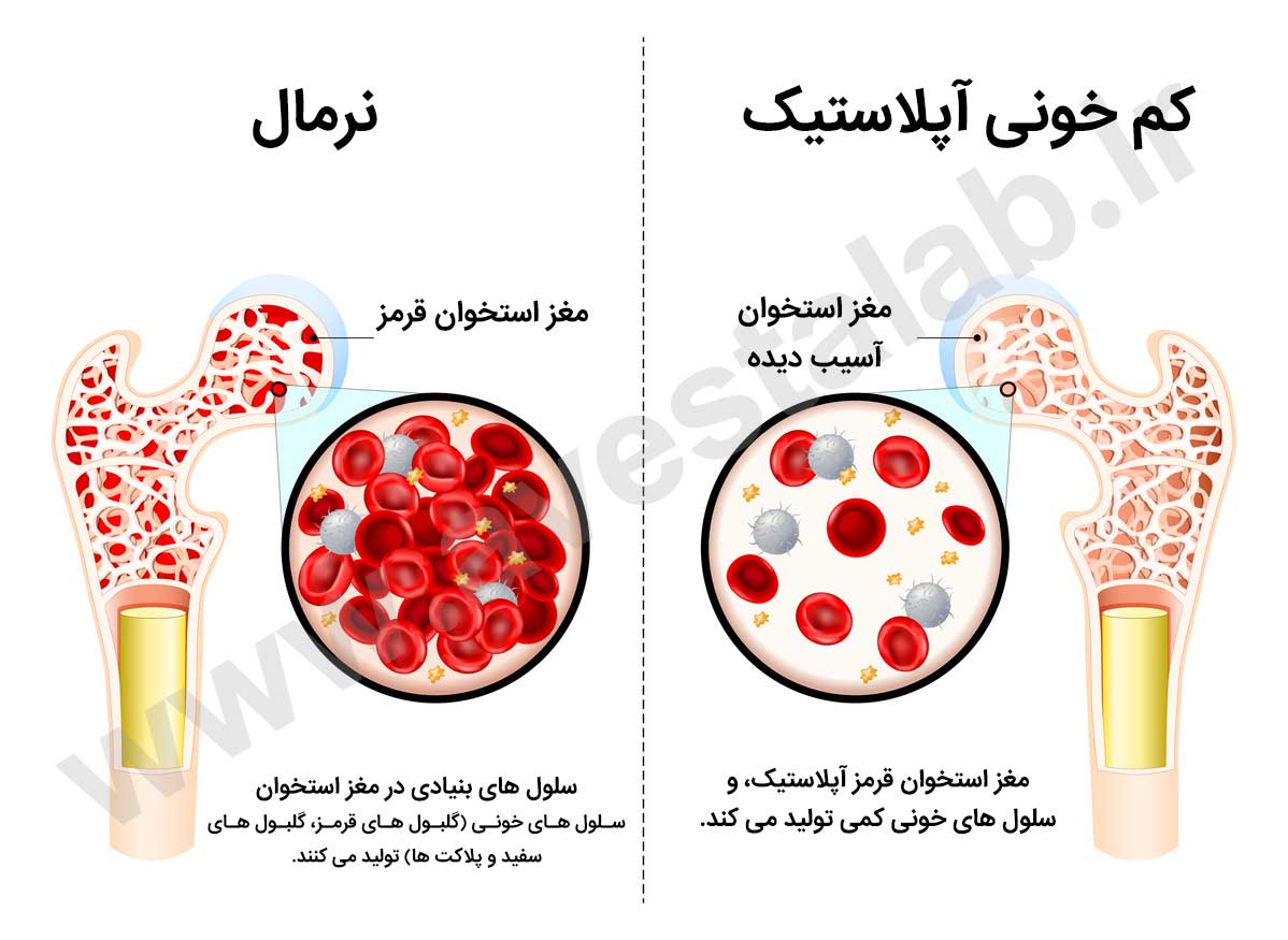 کم خونی آپلاستیک