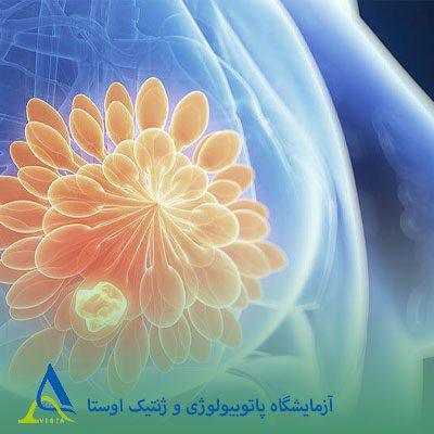 ارتباط سن با سرطان سینه