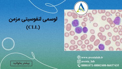 لوسمی لنفوسیتی مزمن (CLL)