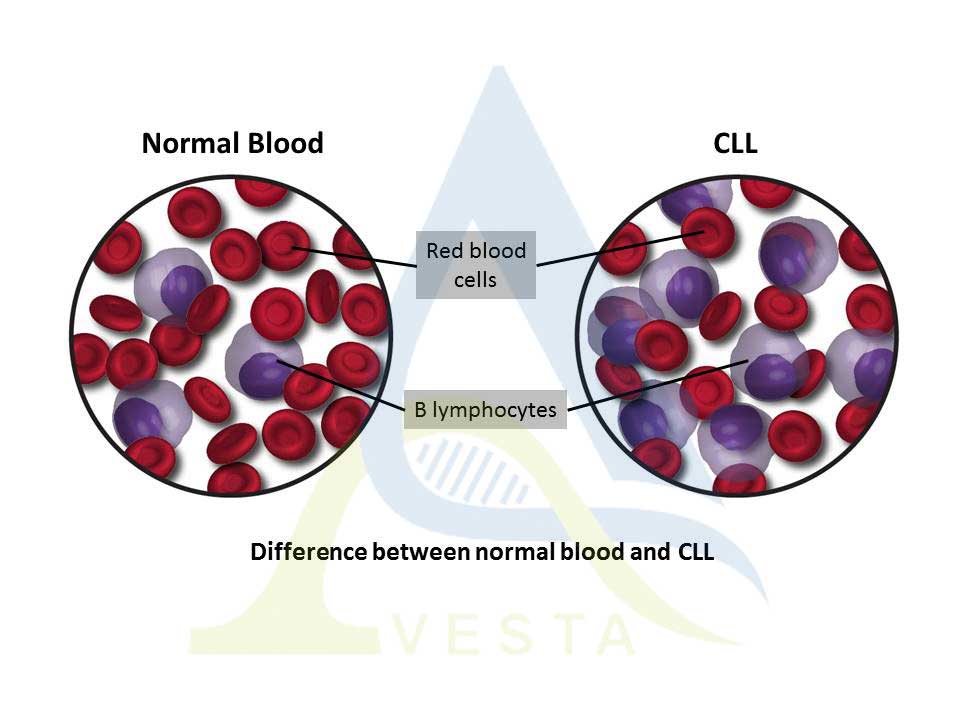 لوسمی لنفوسیتی مزمن (CLL)