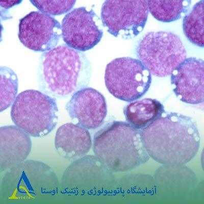 ویروس اپشتاین بار (EBV)
