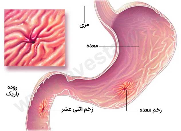 هلیکوباکتر پیلوری (H. Pylori)
