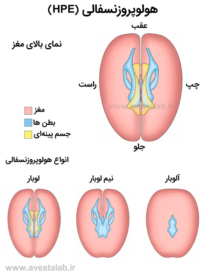 هولوپروزنسفالی (HPE)
