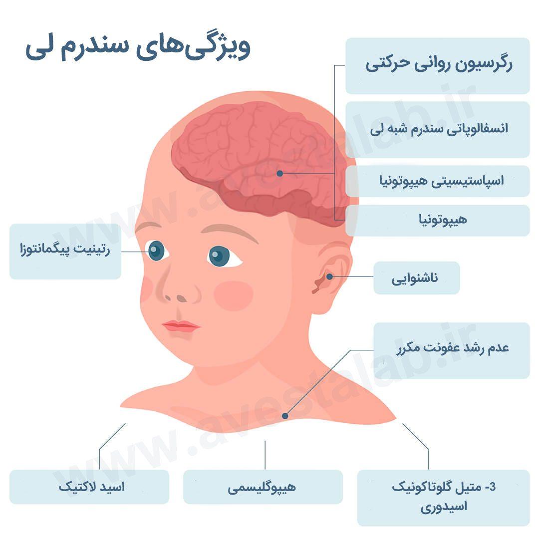 سندرم لی