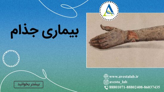 بیماری جذام