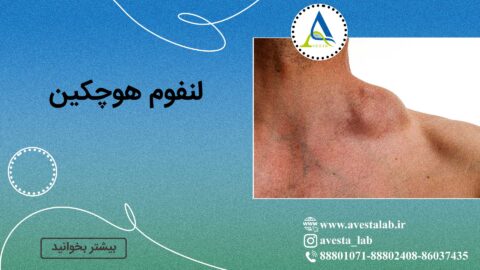 لنفوم هوچکین