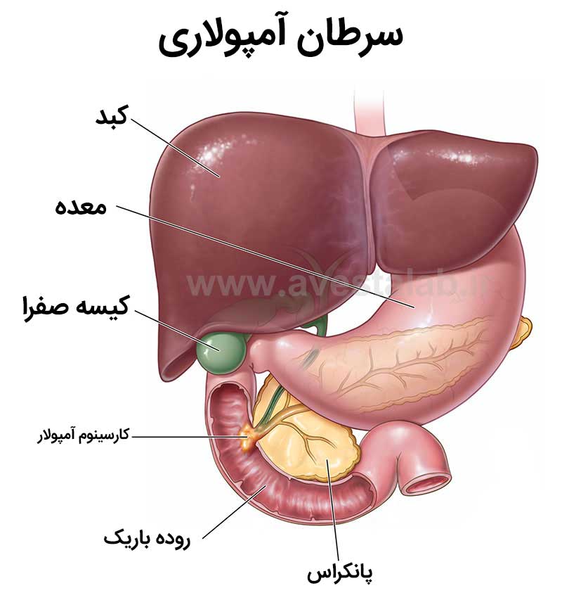 سرطان آمپولاری