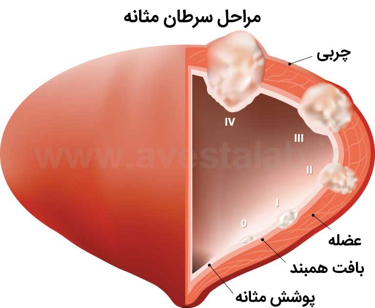 سرطان مثانه