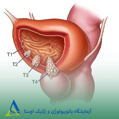 سرطان مثانه