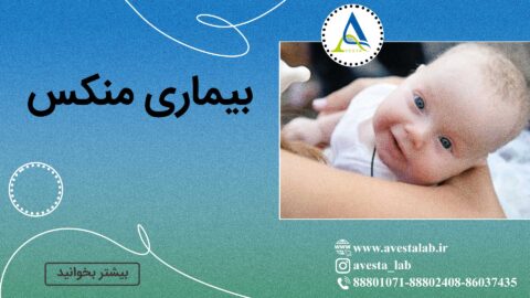 بیماری منکس
