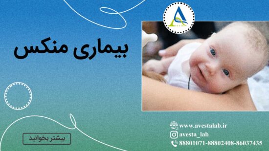 بیماری منکس