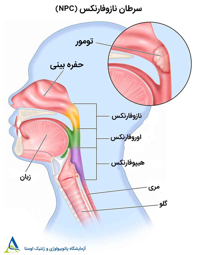 سرطان نازوفارنکس (NPC)