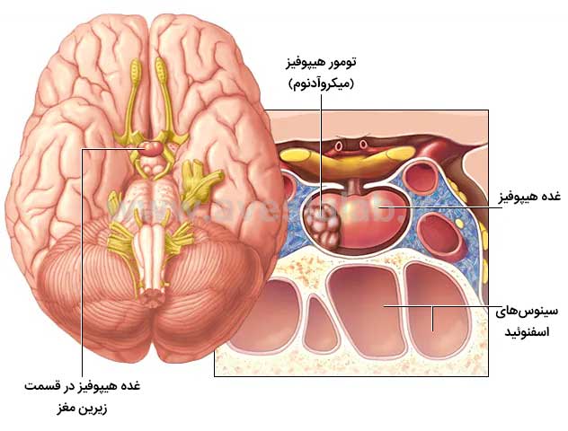 تومورهای هیپوفیز