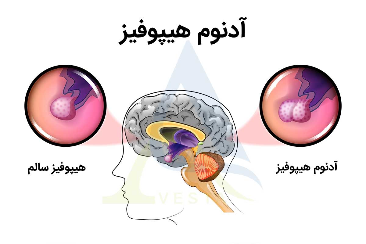 تومورهای هیپوفیز