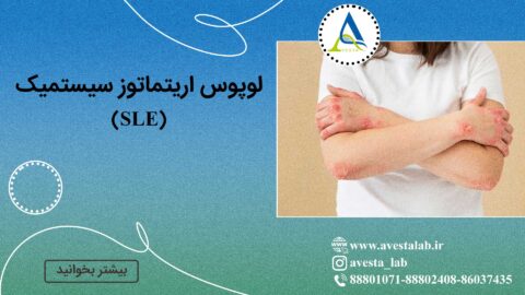 لوپوس اریتماتوز سیستمیک (SLE)