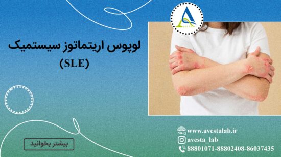 لوپوس اریتماتوز سیستمیک (SLE)