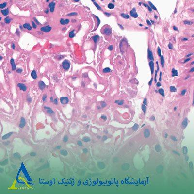 لوپوس اریتماتوز سیستمیک (SLE)