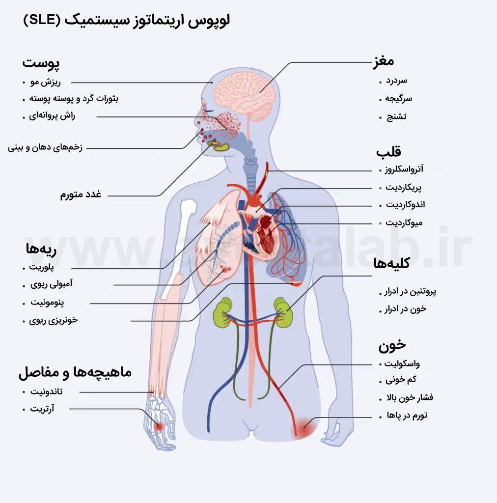 لوپوس اریتماتوز سیستمیک (SLE)