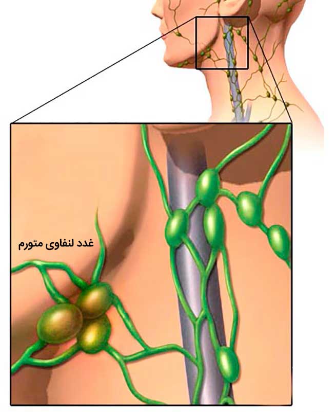 تورم غدد لنفاوی