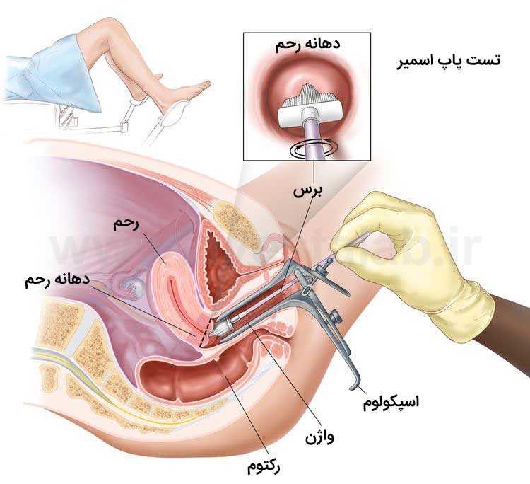 سرطان فرج