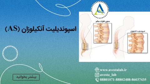 اسپوندیلیت آنکیلوزان (AS)