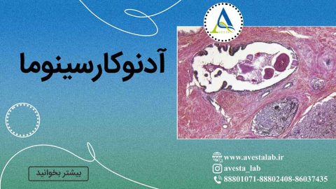 آدنوکارسینوما
