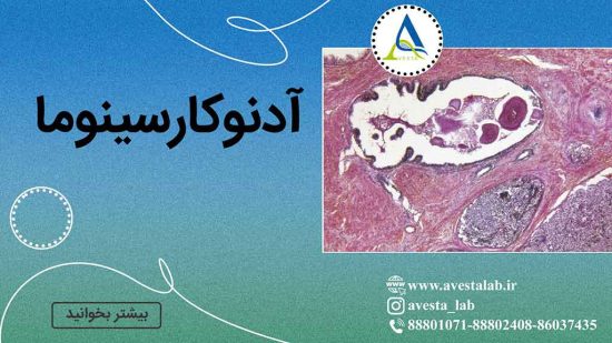 آدنوکارسینوما