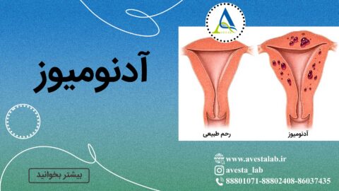 آدنومیوز