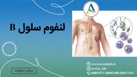 لنفوم سلول B