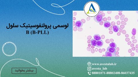 لوسمی پرولنفوسیتیک سلول B (B-PLL)