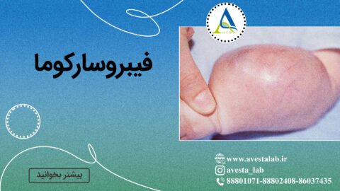 فیبروسارکوما