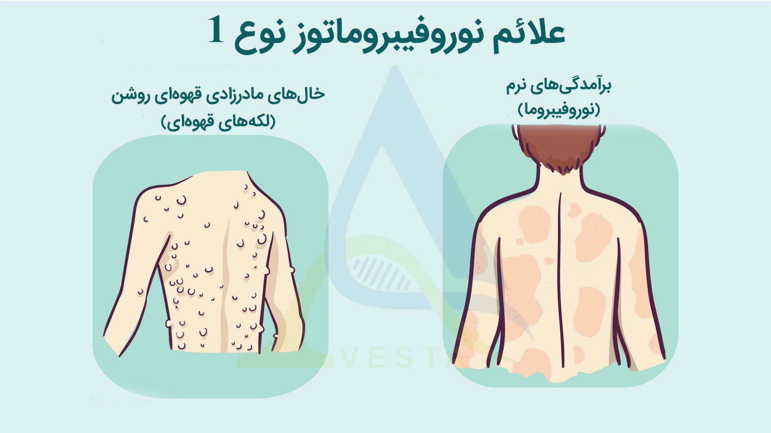 نوروفیبروماتوز نوع 1 (NF1)