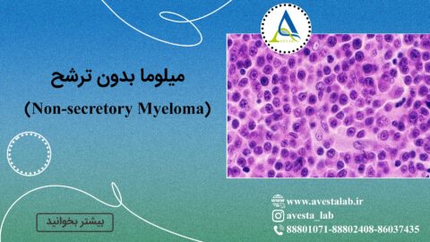 میلوما بدون ترشح (Non-secretory Myeloma)