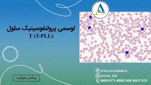 لوسمی پرولنفوسیتیک سلول T (T-PLL)