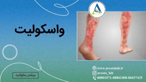 واسکولیت