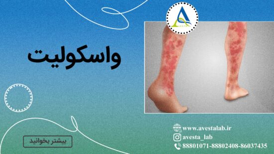واسکولیت