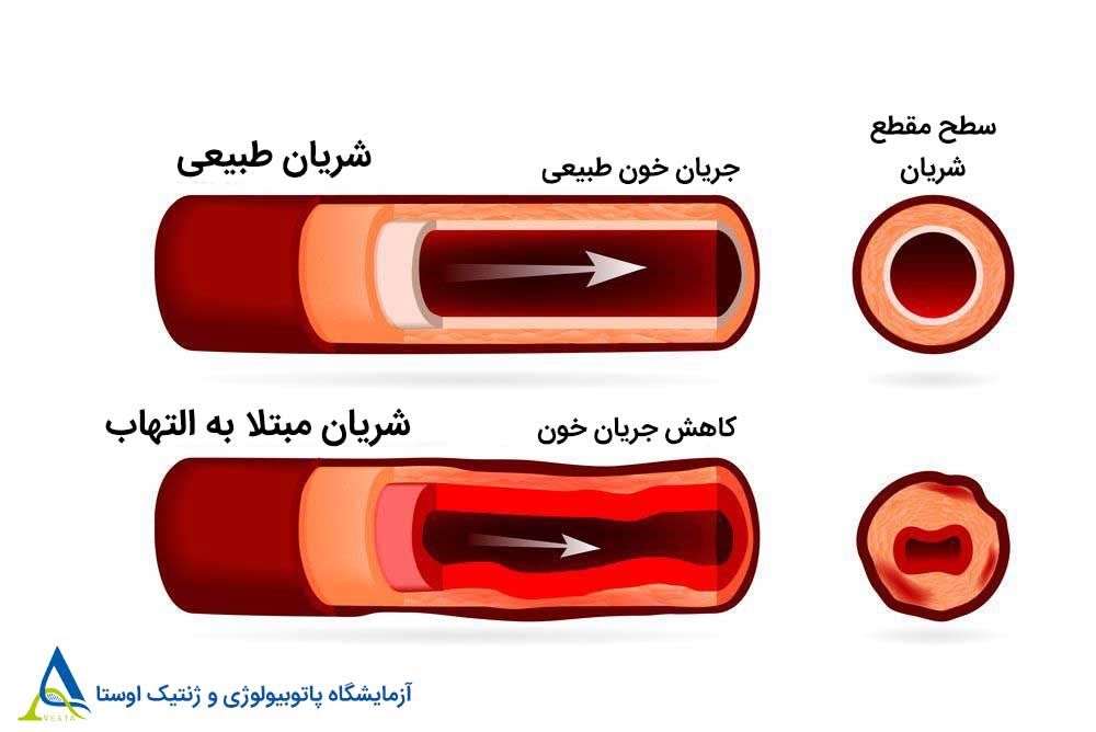 واسکولیت