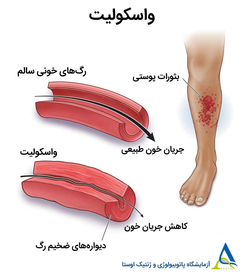 واسکولیت