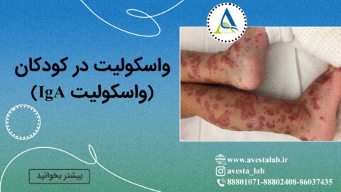 واسکولیت در کودکان (واسکولیت IgA)