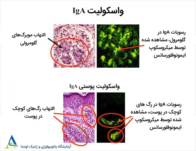 واسکولیت در کودکان (واسکولیت IgA)