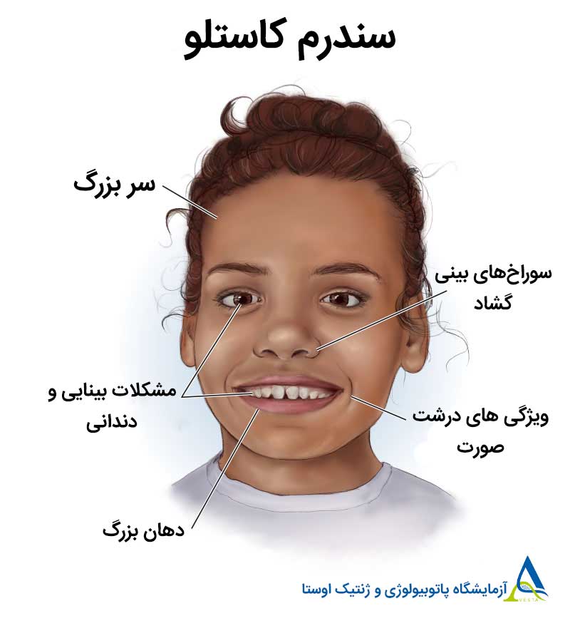 سندرم کاستلو